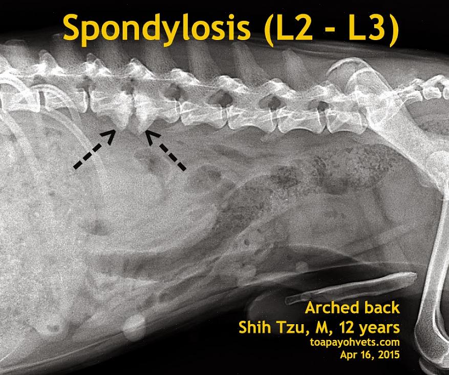 Spondylose er en sykdom i ryggraden hvor beinsporer (osteofytter) utvikles rundt kantene på ryggvirvlene